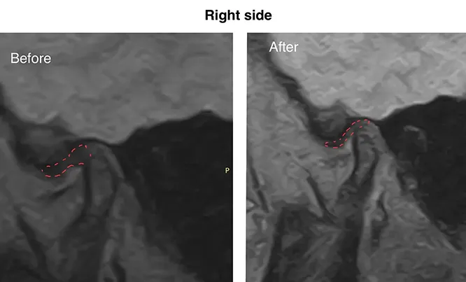MRI of the right temporomandibular joint before and after treatment, joint disc outlined
