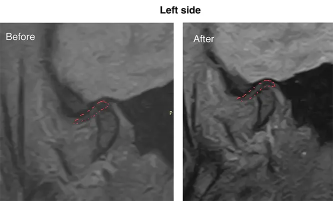 MRI of the left temporomandibular joint before and after treatment, joint disc outlined